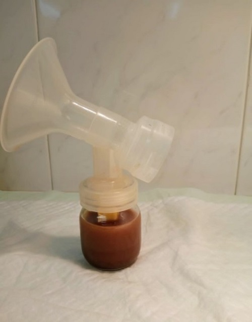 Figura 1. Síndrome de rusty-pipe o de las tuberías oxidadas: aspecto de la leche extraída (día 1)