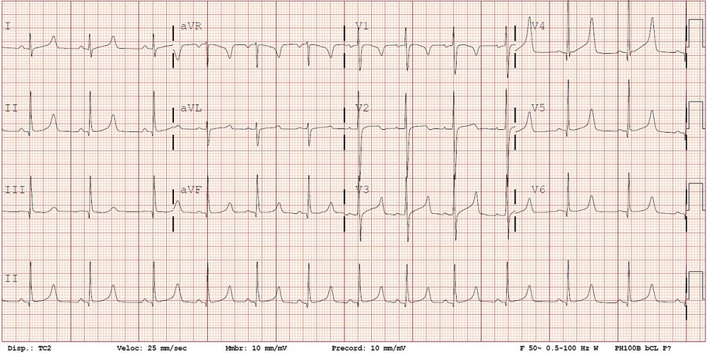 Figura 1. Electrocardiograma de la paciente tras el episodio de pérdida de conciencia