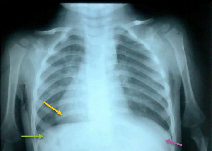 Figura 1. Radiografía anteroposterior de tórax de paciente con situs inverso. Flecha verde: cámara gástrica. Flecha amarilla: ventrículo izquierdo. Flecha morada: sombra hepática.