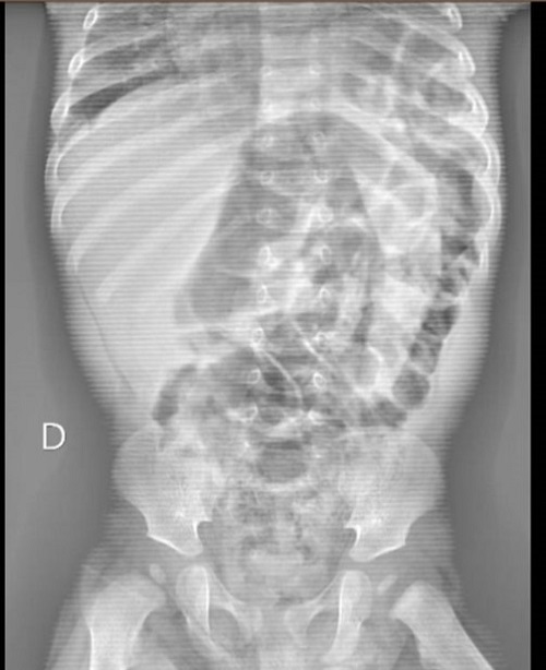 Figura 1. Hernia diafragmática congénita de presentación tardía (paciente de 6 meses): radiografía de abdomen con imagen aérea subdiafragmática