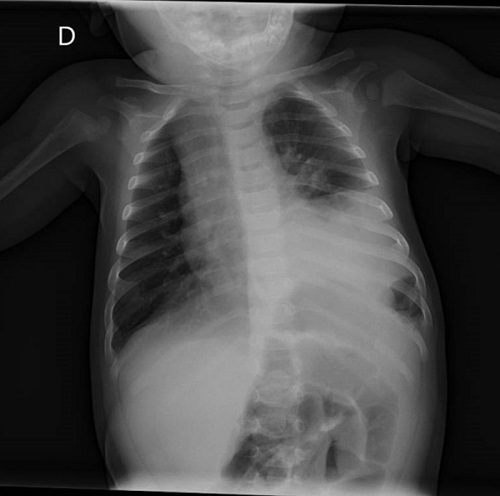 Figura 2. Hernia diafragmática congénita de presentación tardía (paciente de 6 meses): radiografía de tórax con imagen de consolidación basal izquierda; dudosa imagen aérea subdiafragmática