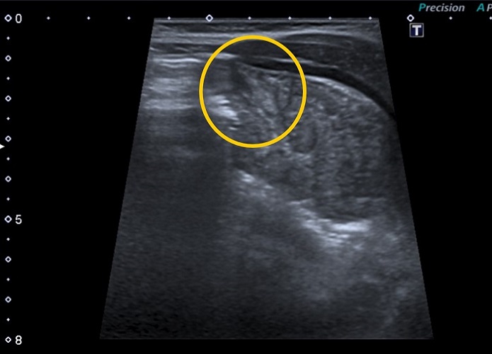 Figura 3. Hernia diafragmática congénita de presentación tardía (paciente de 6 meses). En la ecografía torácica: localización: pared costal izquierda, por encima de la mamila; se observa asas intestinales (círculo rojo)