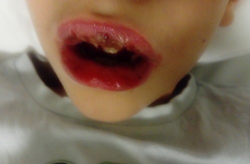 Figura 1. MIRM: mucositis oral con lesiones aftosas- costrosas en labios