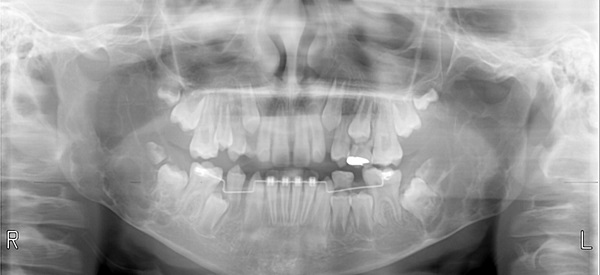 Figura 1. Ortopantomografía: lesiones multiloculares bien definidas en ambas ramas mandibulares