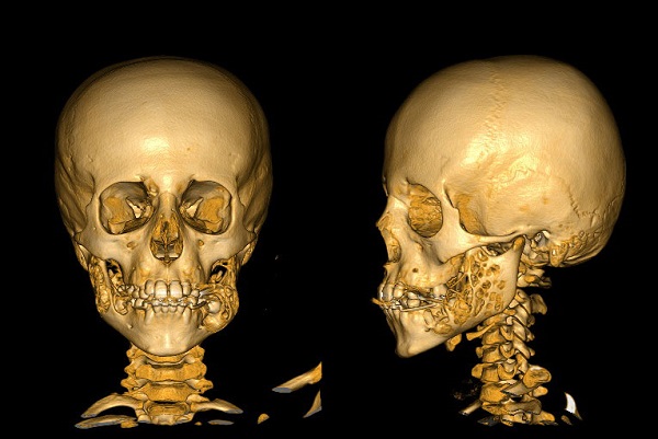 Figura 2. TC con reconstrucción 3D: afectación de ambas ramas mandibulares por un proceso multilocular con significativo ensanchamiento óseo y remodelación, compatible con proceso displásico mandibular (querubismo)