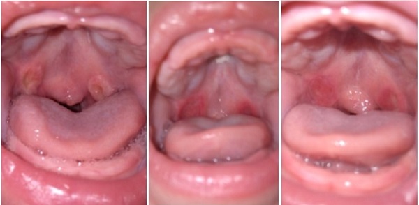 Figura 1. Evolución cronológica de las úlceras de Bednar. De izquierda a derecha: úlceras con aspecto amarillento por la capa de fibrina. Tras su desprendimiento la zona queda con un intenso eritema. Diminución de la intensidad hipéremica hasta su resolución