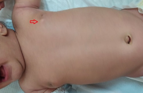 Figura 2. Intumescencia mamaria neonatal de gran tamaño con un quiste mamario izquierdo (flecha)