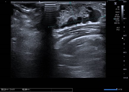 Figura 3. Ecografía: glándula mamaria derecha aumentada de tamaño (32,2 mm en su eje longitudinal y 13 mm en su eje anteroposterior) con mínima hiperecogenicidad central y múltiples lesiones quísticas periféricas, sin asociar alteración de la grasa subcutánea 