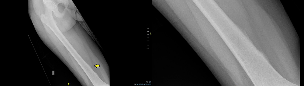 Figura 1. Radiografía de fémur. Triángulo de Codman (flecha) 