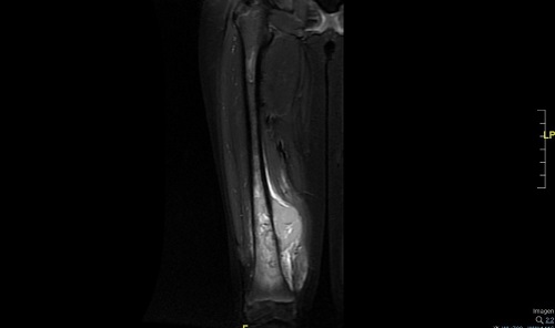 Figura 2. Resonancia magnética Lesión agresiva medular ósea (10 cm de extensión cráneo-caudal) con masa de partes blandas paraostal (35 × 62 × 42 mm) que sobreeleva el periostio en fémur distal derecho