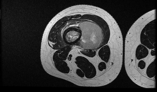 Figura 3. Resonancia magnética Lesión agresiva medular ósea (10 cm de extensión cráneo-caudal) con masa de partes blandas paraostal (35 × 62 × 42 mm) que sobreeleva el periostio en fémur distal derecho