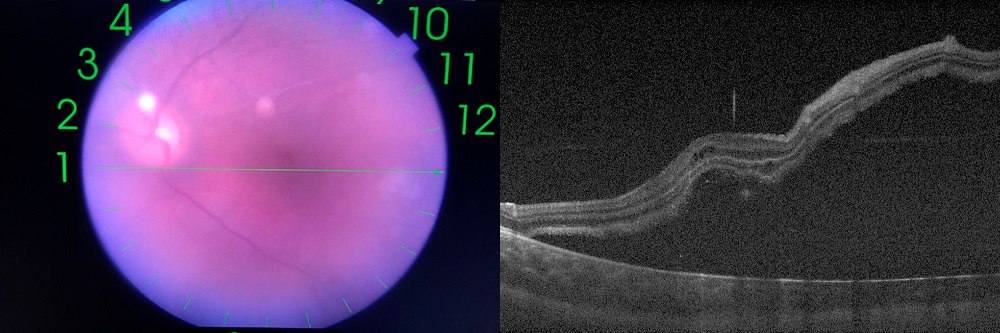 Figura 1. Desprendimiento crónico de retina secundario a desgarro retiniano gigante en región temporal inferior de OI