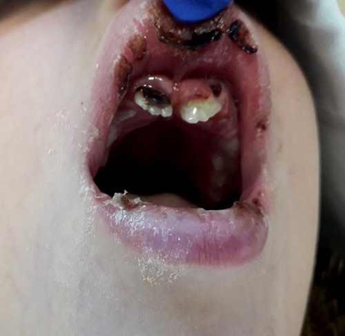 Figura 1. En la exploración observamos una cavidad oral con importante edema de la encía superior izquierda a nivel de los incisivos, con salida de larvas de la misma, separación de la mucosa gingival de la corona y restos de fibrina sin supuración  