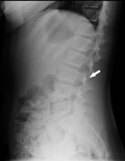 Figura 3. Radiografía lateral de columna vertebral: lesión ósea inespecífica con reacción esclerótica en elementos posteriores de L3 (flecha)