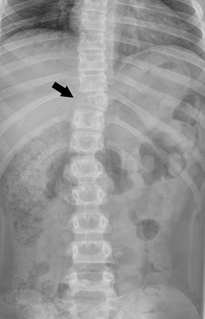 Figura 1. Radiografía anteroposterior de columna vertebral: lesión lítica en pedículo derecho de T10 (flecha). 