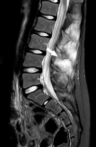 Figura 4. RM de columna vertebral: realce tras administración de contraste secundario a edema de médula ósea y partes blandas circundantes a la lesión. 