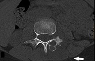 Figura 6. TC de columna vertebral: lesión osteolítica expansiva y multilobulada en lámina y pedículo vertebrales izquierdos de L3 (flecha)