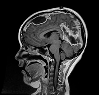 Figura 2. Colecciones subdurales y cerebritis. RM cerebro: colecciones subdurales sugestivas de empiema. Afectación por contigüidad de esplenio de cuerpo calloso, sugestivo de cerebritis. 