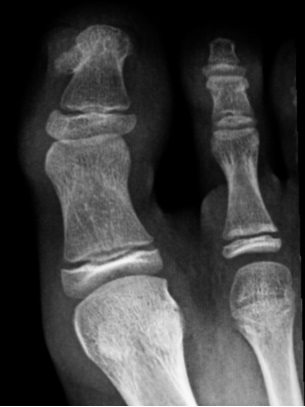 Figura 2. Radiografía del pie derecho. Exostosis en la primera falange