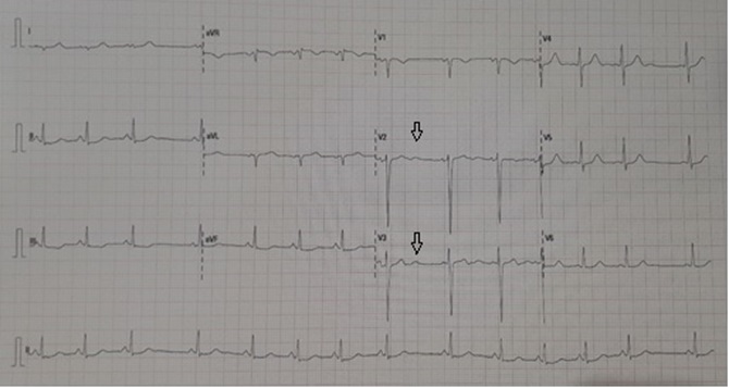 Figura 1. Electrocardiograma: onda U (flecha en la imagen) y alteraciones inespecíficas en la repolarización, como efecto del salbutamol