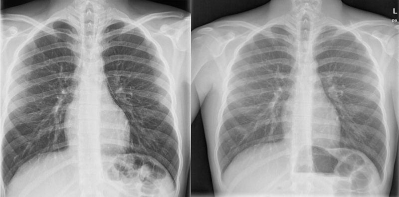 Figure 2. Case 1. Male adolescent aged 16 years who presented to the emergency department with precordial pain with onset 4 hours prior. Chest radiograph with separation of the parietal pleura from the pericardium in the left border of the heart (left image) and normal follow-up radiograph (right image)