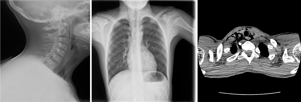 Figure 3. Case 5. Male adolescent aged 13 years referred to the emergency department by his primary care paediatrician for evaluation of right cervical and central chest pain of 5 hours’ duration associated with dyspnoea and difficulty swallowing. Soft-tissue neck and chest radiographs with hyperlucent areas in the right superior mediastinum, continuous diaphragm sign and subcutaneous emphysema in the right side of the neck. Neck and chest CT scan revealed anterior, medial and posterior pneumomediastinum extending cranially into the soft tissues surrounding the trachea and oesophagus toward the right carotid sheath and the right retropharyngeal space.