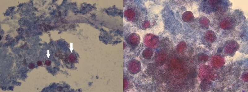 Figura 1. Citología de secreción mamaria. Se observa un fondo proteináceo con células espumosas (flechas).