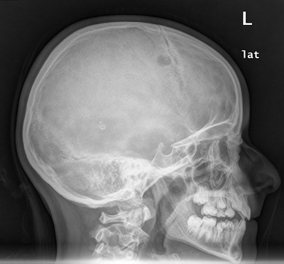 Figura 1. Radiografía craneal en la que se objetiva una imagen radiolucente en parietal derecho, en relación con lesión lítica de 11 mm, sugestiva de HCL ósea monostótica