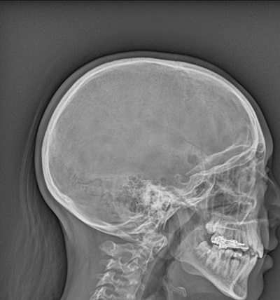 Figura 2. Radiografía craneal en la que se objetiva una lesión osteolítica en porción anterior hueso temporal derecho, sugestiva de HCL ósea monostótica