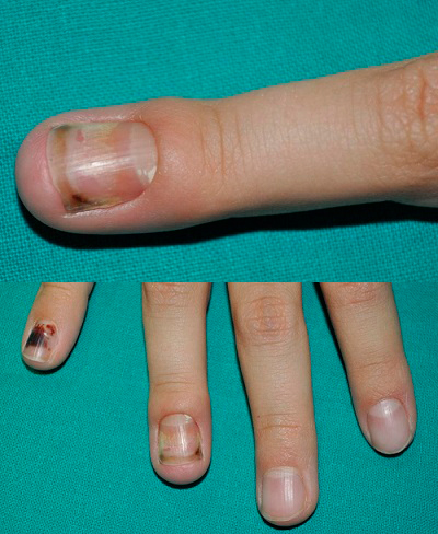 Figura 1. Imagen clínica de retroniquia. En cuarto dedo de la mano presenta: hematoma ungueal, edema y eritema del eponiquio y de pliegues laterales y onicolisis