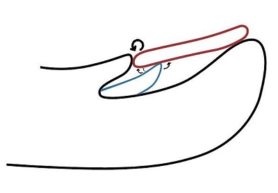 Figura 2. Fisiopatología de la retroniquia: se interrumpe el crecimiento ungueal (rojo) y crece una nueva lámina ungueal (azul), que presiona a la antigua (rojo) y que se enclava en el pliegue proximal