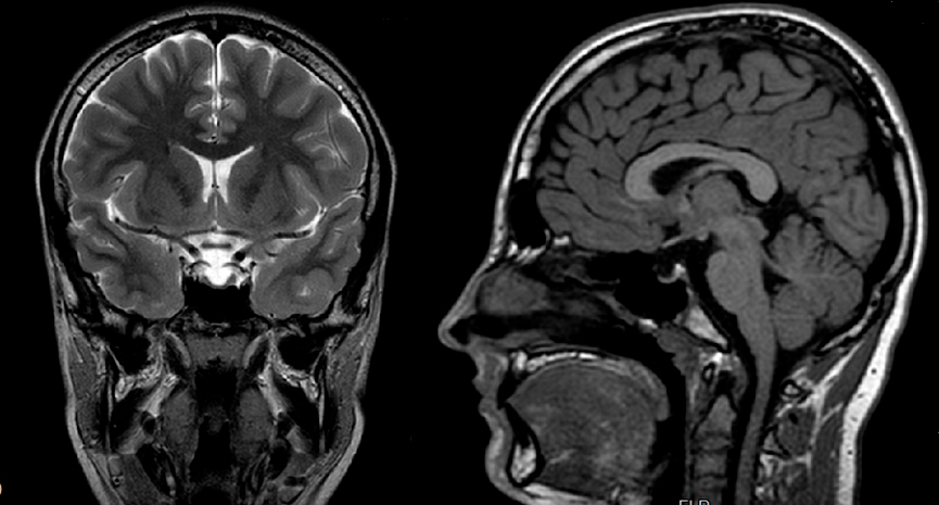 Figura 1. RM cerebral. Corte coronal y sagital. 