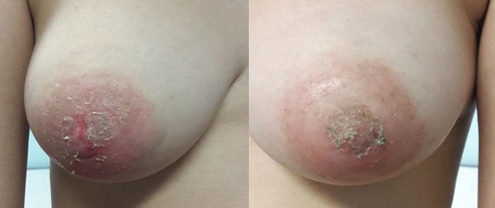 Figura 1. Lesiones eritematosas y costrosas, con alguna grieta, en la zona del pezón y la areola de ambas mamas.