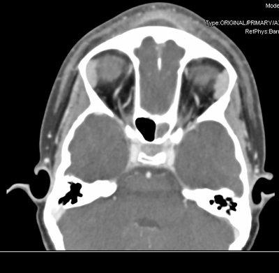 Figura 1. TAC craneal de la paciente donde se objetiva el absceso subperióstico frontal extracraneal