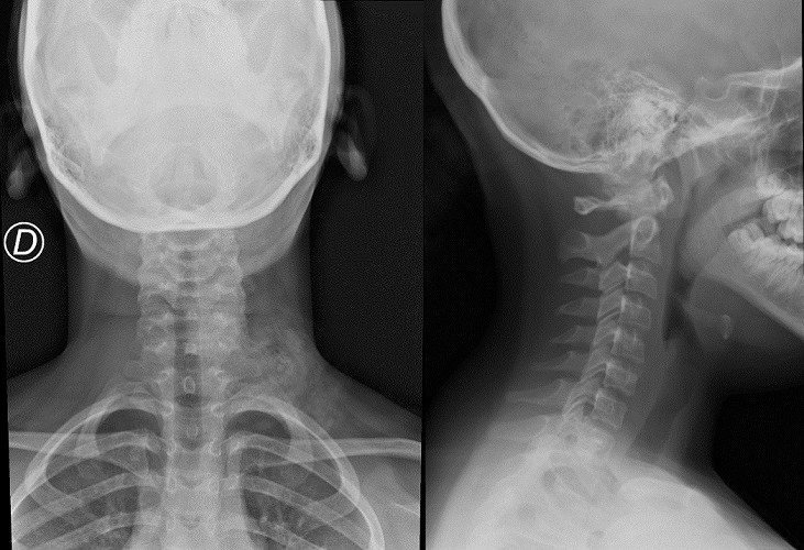 Figura 1. Radiografía cervical anteroposterior y lateral iniciales