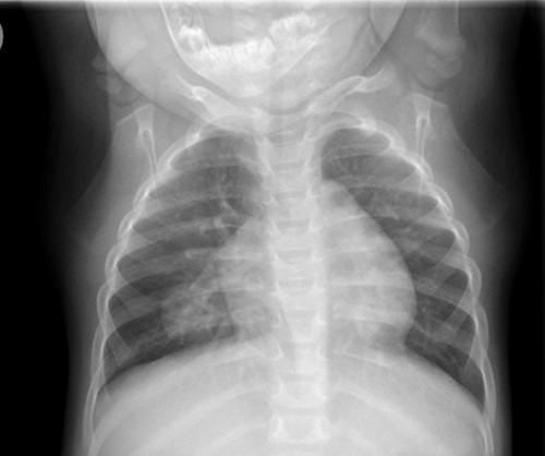 Figura 1. Principales imágenes radiológicas del caso: radiografía de tórax inicial