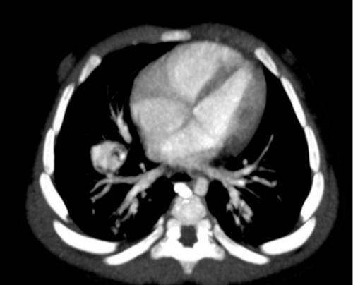 Figura 2. Principales imágenes radiológicas del caso: TC pulmonar inicial