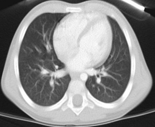 Figura 4. Principales imágenes radiológicas del caso: TC pulmonar de control