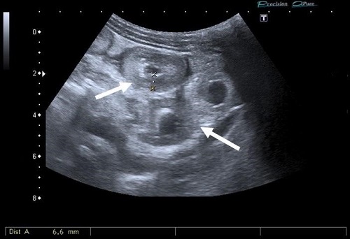 Figura 1. Imagen de ecografía abdominal donde se visualizan asas intestinales (flechas) con importante engrosamiento parietal, de hasta 6,6 mm.