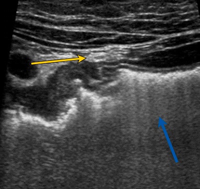 Figura 1. Flecha azul: engrosamiento mural de la pared duodenal y cambios inflamatorios de la grasa adyacente. Flecha amarilla: adenopatía reactiva