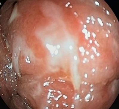 Figura 1. Úlceras amplias cubiertas por fibrina en la mucosa colónica, en un entorno eritematoso y congestivo.