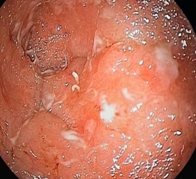 Figura 2. Detalle que muestra la multitud de pequeñas úlceras que salpicaban toda la superficie colónica de la lactante.