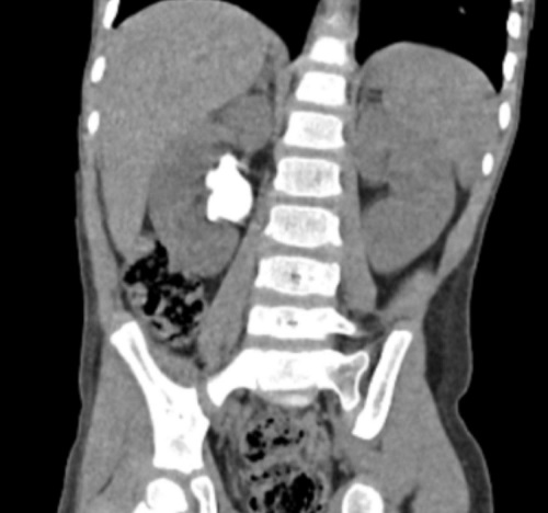 Figura 1. Litiasis urinaria por cistinuria. Imagen de TC del paciente, donde se observa litiasis renal derecha coraliforme