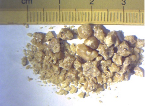 Figura 2. Litiasis urinaria por cistinuria. Cálculo renal fragmentado extraído en la intervención. Peso: 1,28 g