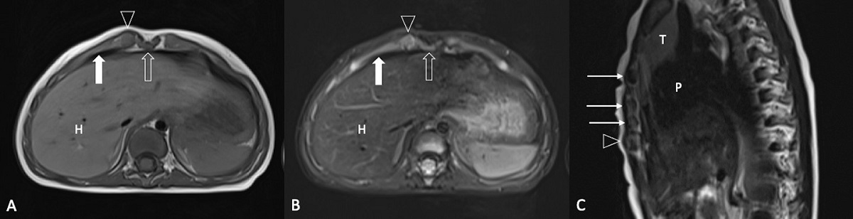 Figura 2. Tumor esternal autolimitado de la infancia (SELSTOC). Resonancia magnética de tórax sin administración de contraste intravenoso realizada a los 4 meses. Imágenes axiales potenciadas en T1 (A) y T1 con supresión grasa (B), que confirman la desaparición de la lesión de partes blandas; existe hipertrofia del margen condral (punta de flecha) de una articulación condroesternal derecha, sin alteraciones asociadas en la grasa subcutánea ni en el cartílago costal adyacente (flecha gruesa). En la imagen sagital potenciada en T2 (C) se aprecia el aumento de tamaño focal de un cartílago costal (punta de flecha) respecto a los tres cartílagos costales superiores (flechas finas), que corresponde a una variante anatómica.