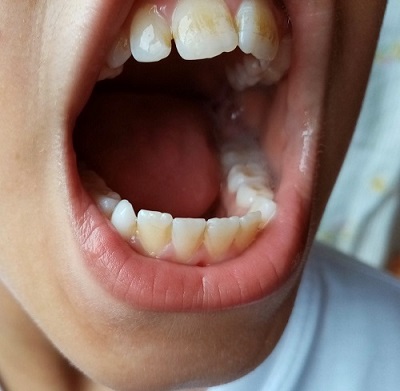 Figura 1. Tinción dental por cloro: tinción marronácea dental de predominio en incisivos