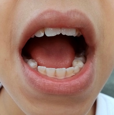 Figura 2. Tinción dental por cloro: disminución de las manchas dentales tras limpieza
