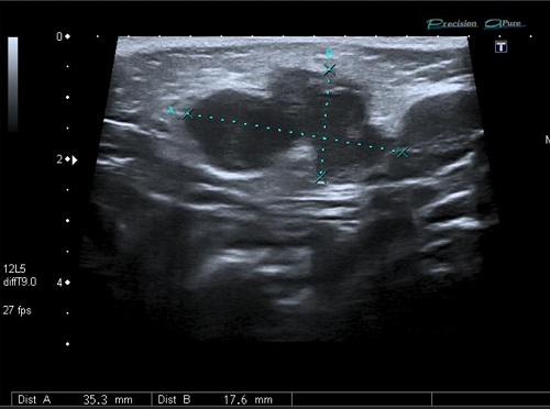 Figura 1. Paciente de 23 meses. Ecografía de nódulo cervical por micobacterias no tuberculosas (M. lentiflavum)