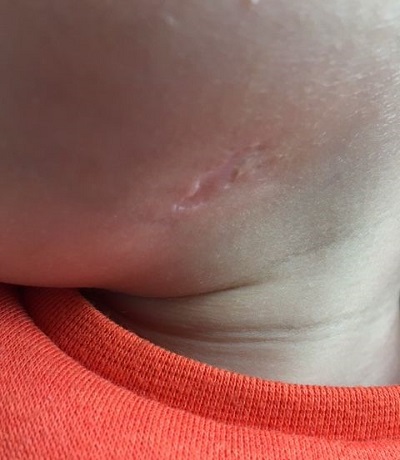 Figura 3. Paciente de 23 meses. Linfadenitis cervical por micobacterias no tuberculosas. Cicatriz residual