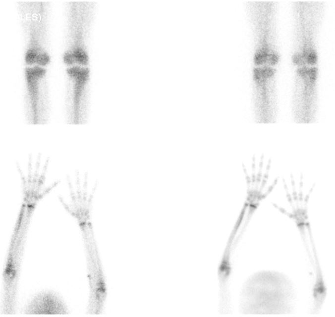 Figura 2. Gammagrafía ósea al ingreso. En la fase de pool vascular, discreto aumento de captación a nivel de segunda articulación metacarpofalángica derecha. En la fase ósea se visualiza moderada hipercaptación en mitad distal del cúbito derecho. Sin alteraciones gammagráficas en rodillas